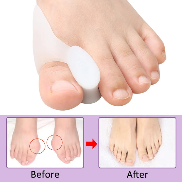 Bunion Corrector